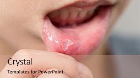  Presentation with disease - Presentation design with oral disease - woman suffer from aphtha background and a coral colored foreground