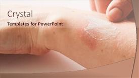  Presentation with burn - Amazing presentation design having woman applying scars removal cream to heal the first degree - heat burn wound on her hand backdrop and a lemonade colored foreground