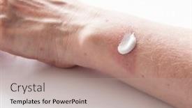  Presentation with scars - Audience pleasing presentation design consisting of woman applying scars removal cream to heal the first degree - heat burn wound on her hand backdrop and a light gray colored foreground