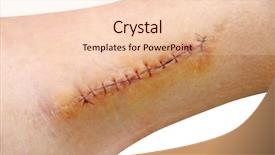  Presentation with ankle - PPT layouts featuring wound - stitches in the leg ankle background and a lemonade colored foreground
