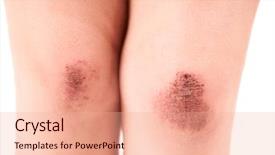  Presentation with wound care - Amazing slide deck having wound care - scraped knees of a little backdrop and a coral colored foreground