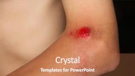  Presentation with wound care - Audience pleasing slides consisting of wound care - scraped up bleeding elbow backdrop and a coral colored foreground