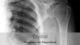  Presentation with joints - Amazing PPT theme having x-ray image of human shoulder ribs scapula and joints isolated on black medical and science technology backdrop and a light gray colored foreground
