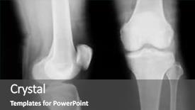  Presentation with knee - Audience pleasing slides consisting of x-ray of both human backdrop and a dark gray colored foreground