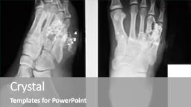  Presentation with human foot - Slide deck with x-ray of both human background and a gray colored foreground