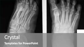  Presentation with human foot - Amazing slide deck having x-ray of both human backdrop and a gray colored foreground