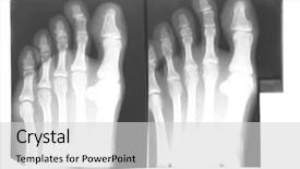  Presentation with feet - Slide set with x-ray of feet isolated background and a light gray colored foreground