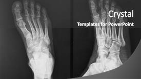  Presentation with anatomy foot - PPT theme consisting of x-ray of foot background and a dark gray colored foreground