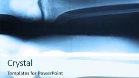  Presentation with human - Amazing presentation theme having x-ray of human knees backdrop and a cool aqua colored foreground