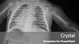  Presentation with x ray lung - Beautiful PPT layouts featuring x-ray of young boy backdrop and a gray colored foreground