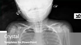  Presentation with x ray lung - Slide set featuring x-ray of young boy background and a gray colored foreground