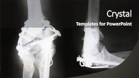  Presentation with fracture bone - Beautiful presentation theme featuring x-ray picture showing fractured backdrop and a black colored foreground