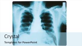  Presentation with chest - Presentation design enhanced with x-ray image of chest background and a light blue colored foreground