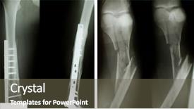  Presentation with xray - Cool new presentation theme with xray knee - x-ray of both human legs backdrop and a tawny brown colored foreground