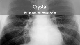  Presentation with lung - Presentation design enhanced with xray of the chest background and a gray colored foreground