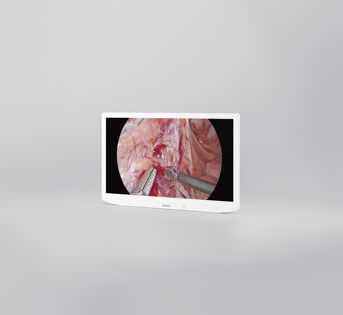 Présentation du LMD-32M1MD : Moniteur chirurgical avancé ACL 4K HDR Mini-LED de 32 pouces de Sony Electronics - Avec une luminosité, une clarté et des détails visuels exceptionnels