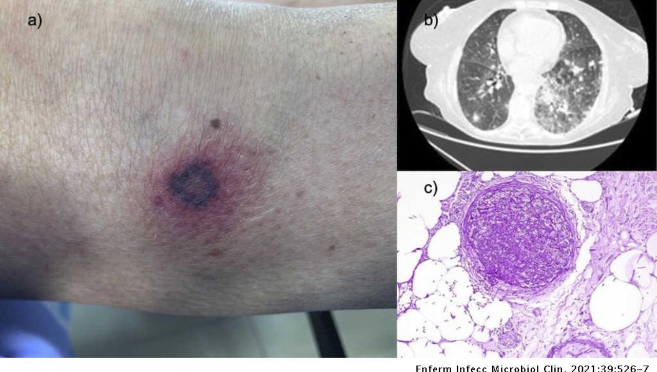 Enfermedades e infecciones causadas por Pseudomonas aeruginosa, ¿cuáles
