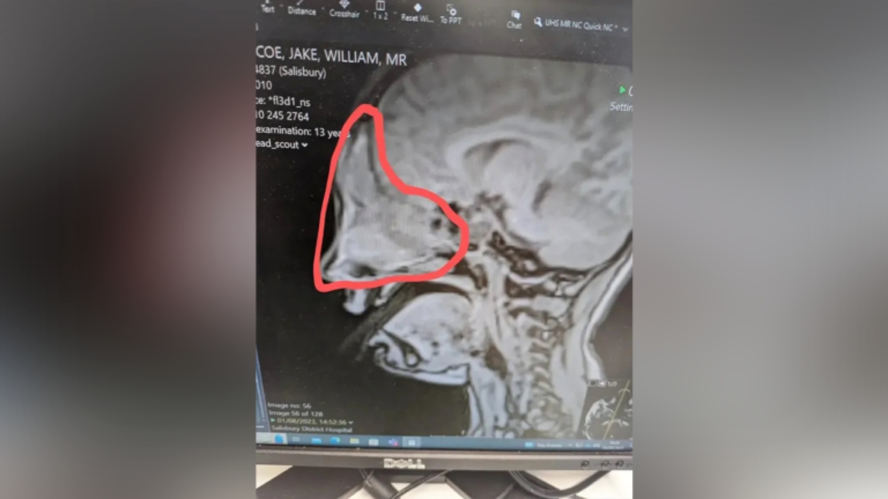 Madre pensó que su hijo tenía alergia pero meses después murió de cáncer