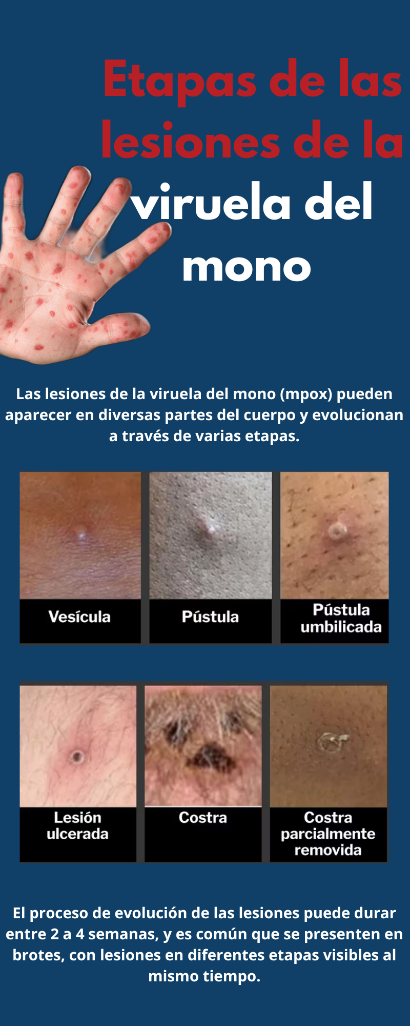 Conoce los síntomas de la viruela del mono (mpox)