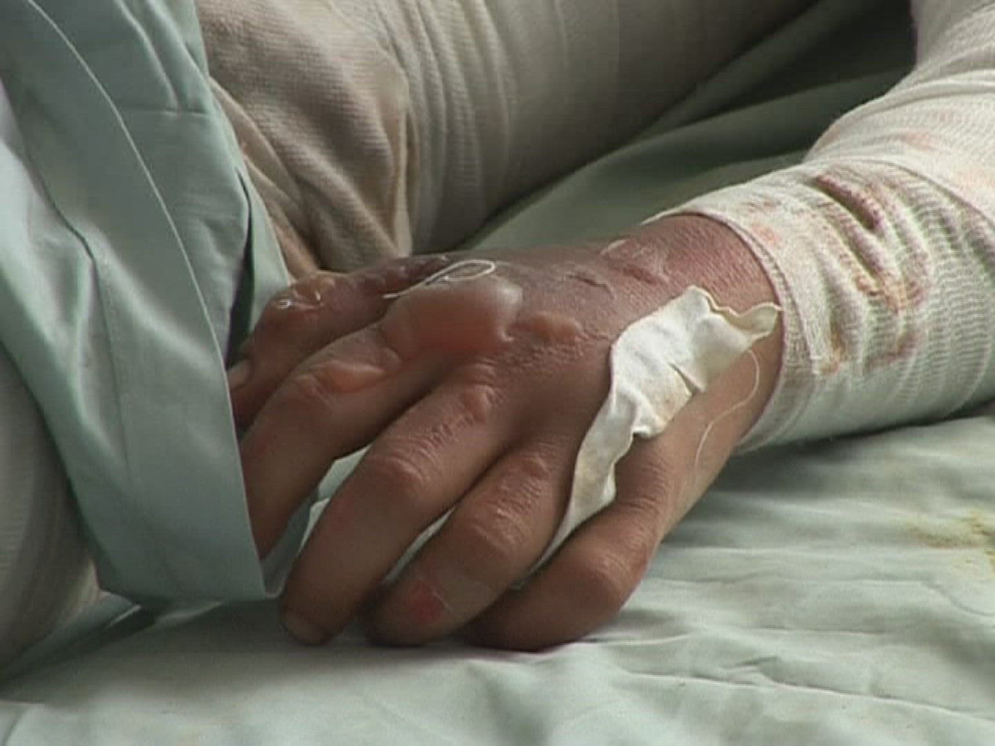 571181102 / Woman / Self-immolation / Afghanistan
