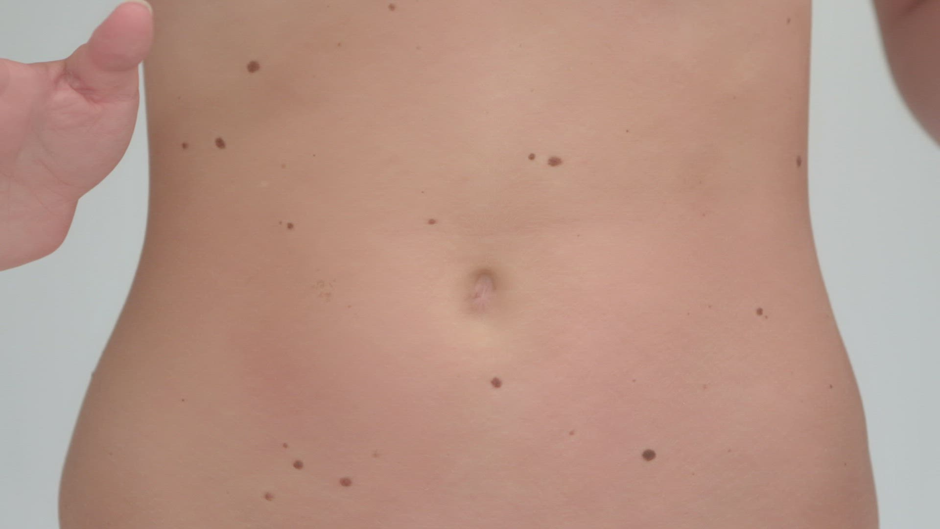 294185192 / Abdomen / Hand / Liver Spot
