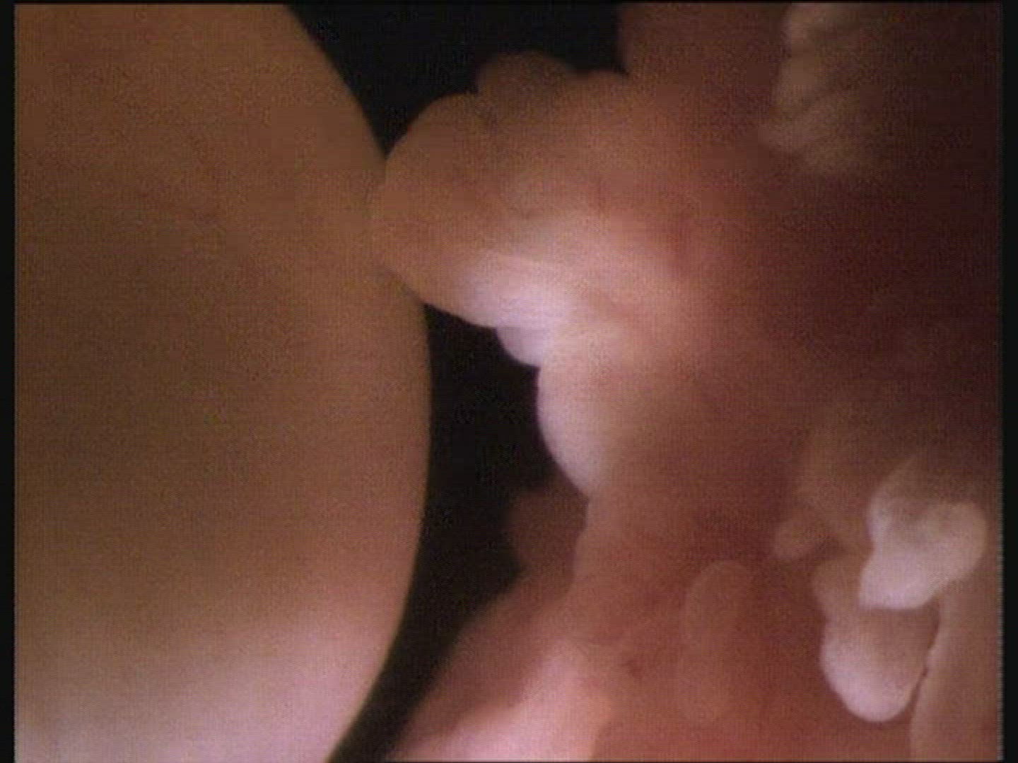 Ovulation. Human ovary prior to egg release with fimbriae