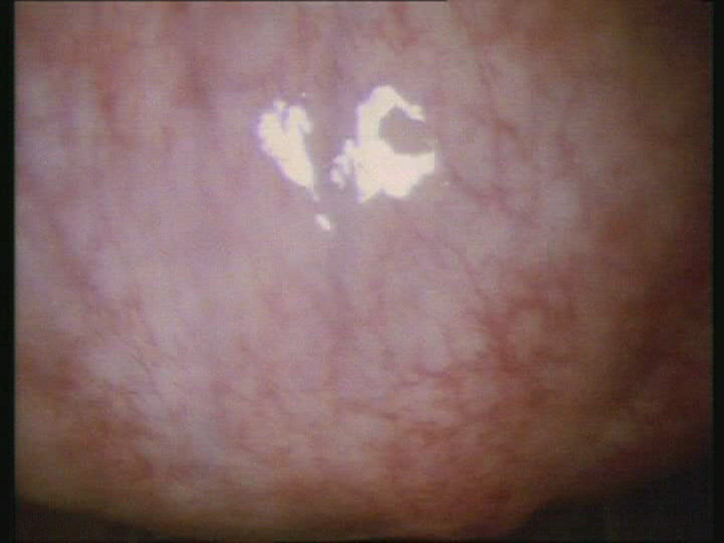 Human Ovary with Uterine tube inside body