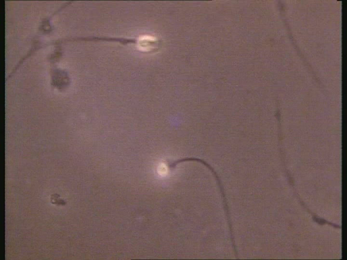 abnormal sperm
