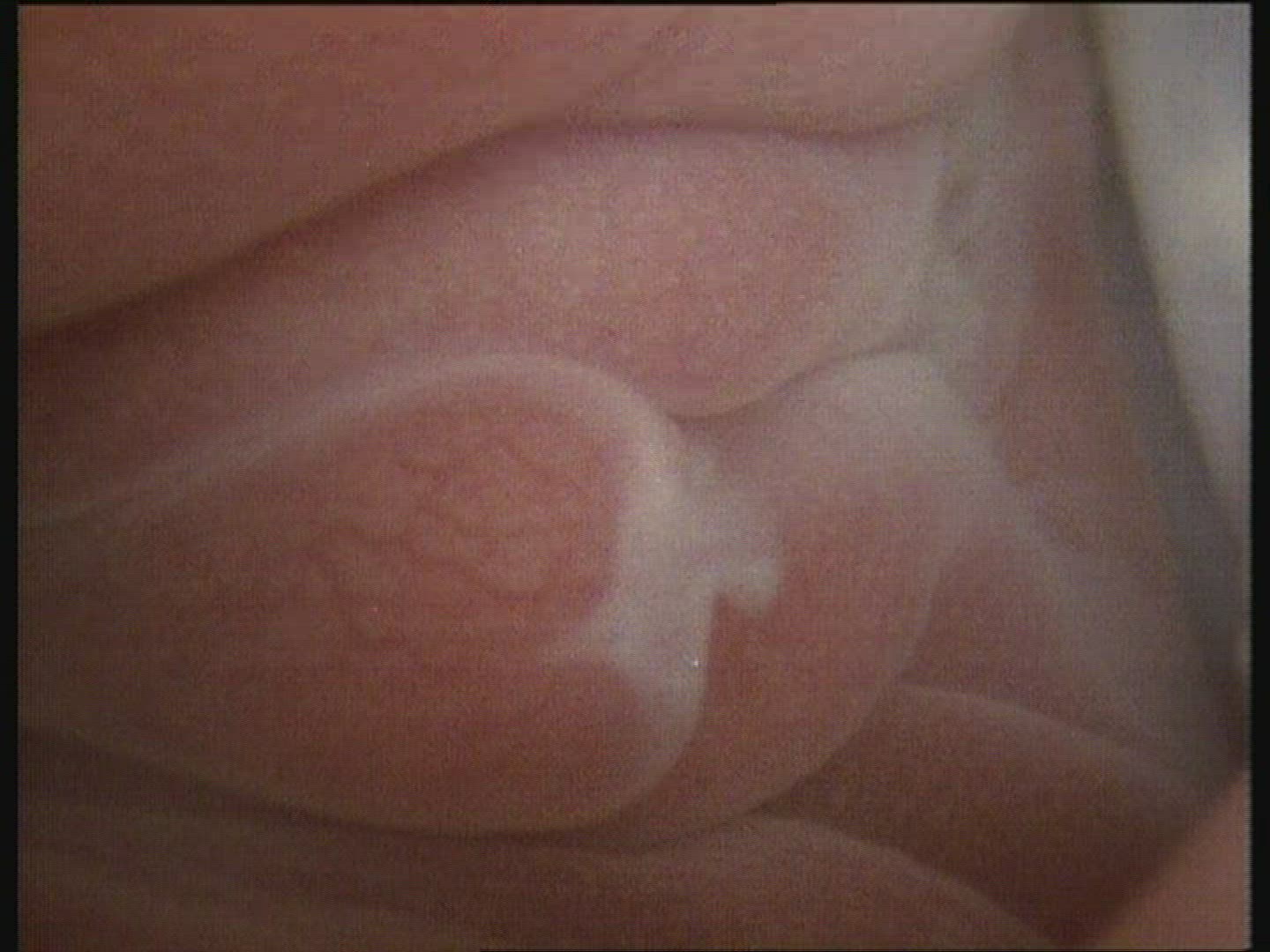 Foetus in the womb 24 weeks. Genitalia