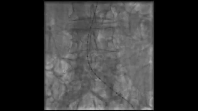 Carotid Artery 3729