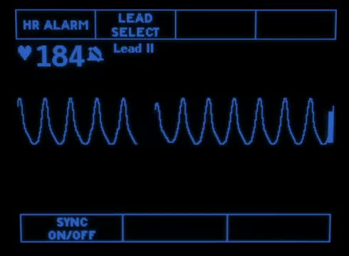 Ventricular Tachycardia 1874