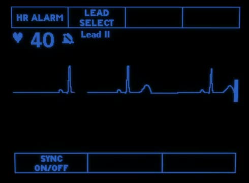 Sinus Bradycardia 1870