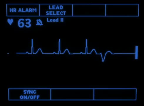 Normal Sinus Rhythm with PVC 1867