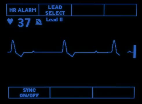Complete Heart Block 1861