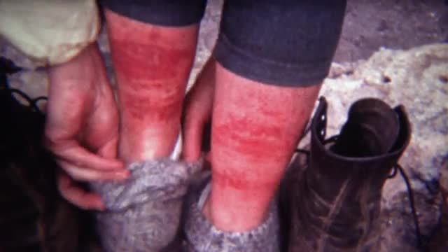 1972: Women pulling down socks to show off red chigger insect bites.