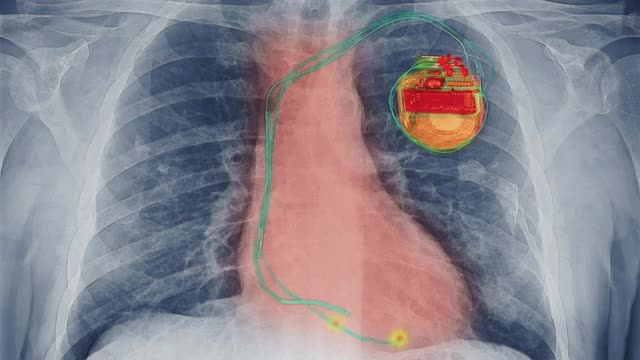Computer animation of pacemaker firing
