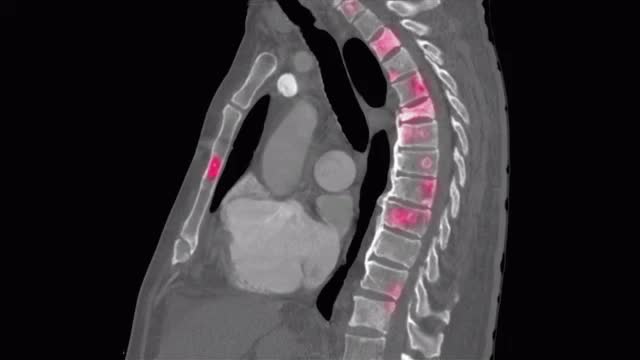 Metastatic lesions to spine