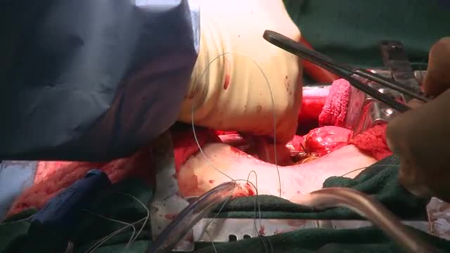 Heart beating during open heart surgery (2 of 2)