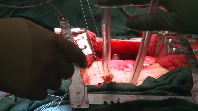 Heart beating during open heart surgery (1 of 2)