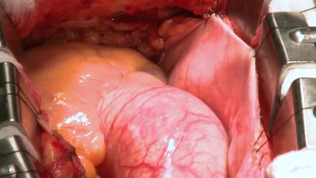 Heart beats through open chest during surgery (8 of 9)