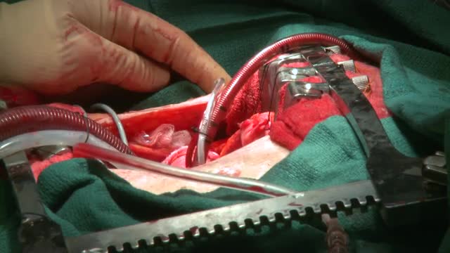 Heart pulses while connected to bypass machine