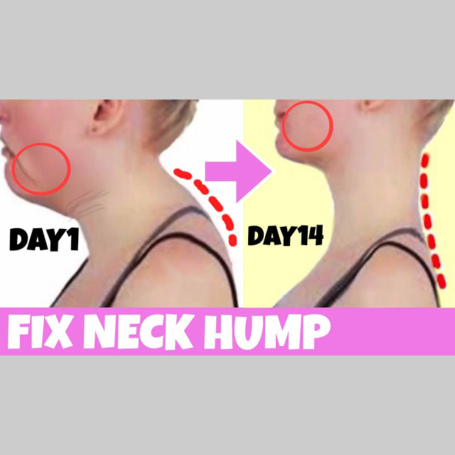 Fix Neck Hump - Moderate Workout by Tanya P - Skimble