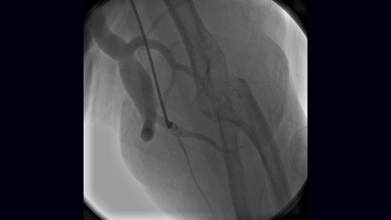 Arteriovenous Fistula for Hemodialysis Complicated by a Giant Venous