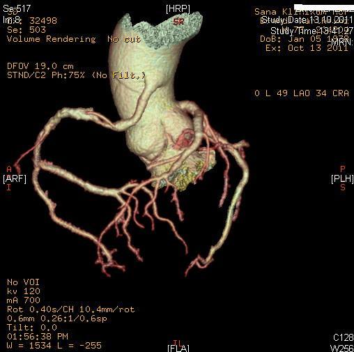 Use of the Left Judkins Guiding Catheter in an Anomalous Right Coronary