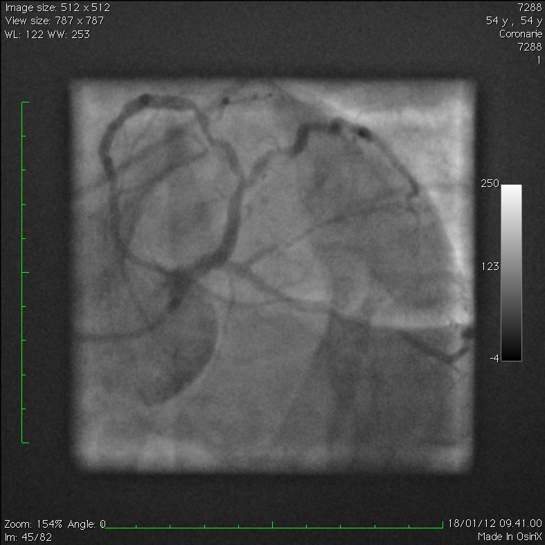 Extensive Intramural Coronary Hematoma Following Balloon Catheter