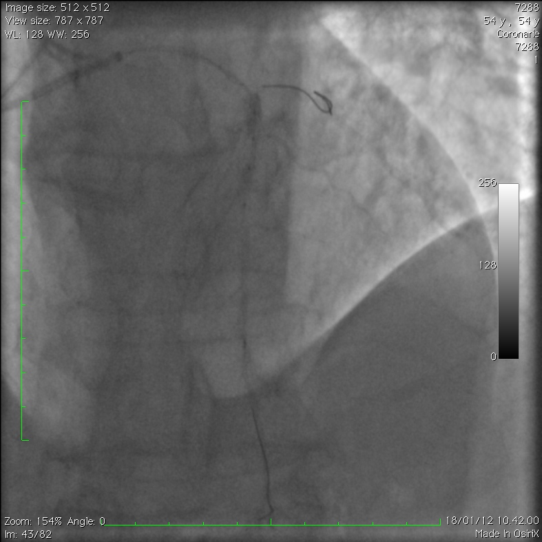 Extensive Intramural Coronary Hematoma Following Balloon Catheter