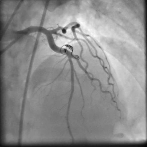 Complete Closure of a Coronary ArteryVenous Fistula by Coil
