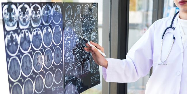 Stroke After PCI Rare but Rising as Patient Complexity