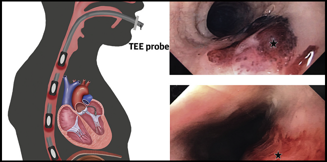 High Tee Injury Rate In Structural Heart Interventions Warrants Caution Tctmd Com