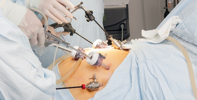 Bariatric Surgery Tied to Better Long-term Outcomes After MI | tctmd.com